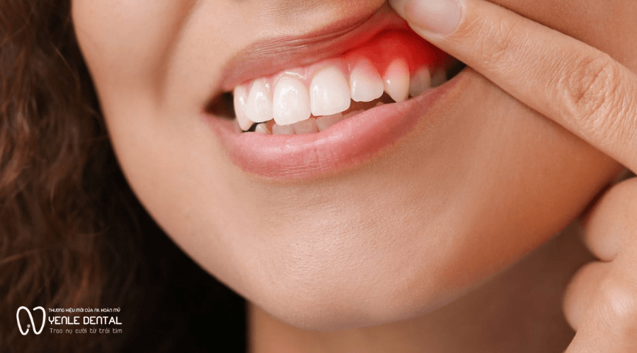 dấu hiệu sưng nướu
